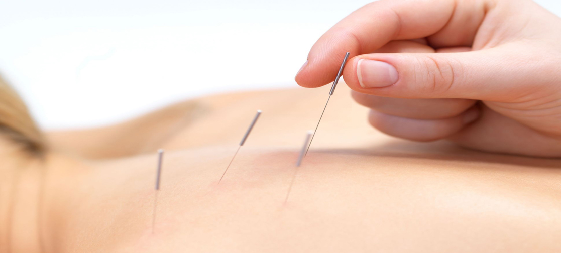 acupuncture